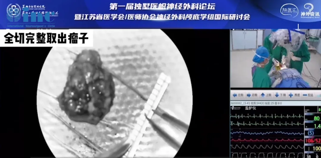 阿朔手術(shù)直播中，在術(shù)中神經(jīng)電生理監(jiān)測(cè)下，巴教授順利全切取出腫瘤