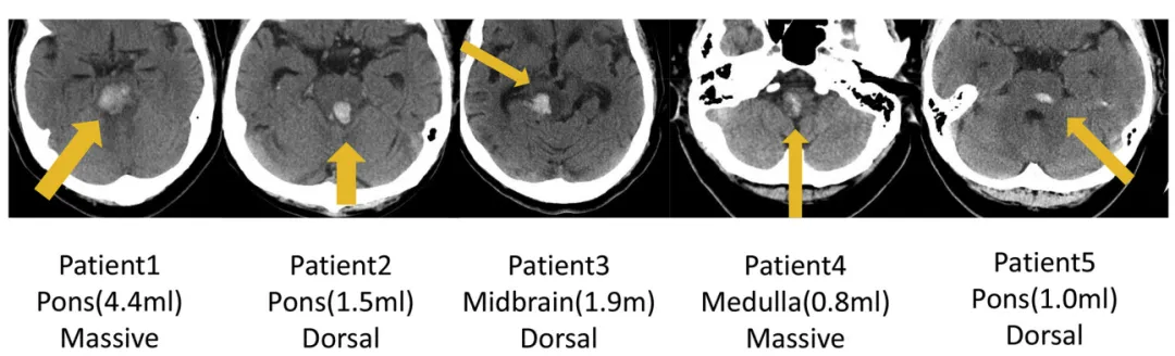 圖：5例原發(fā)性腦干出血（PBH）患者的軸位CT影像。