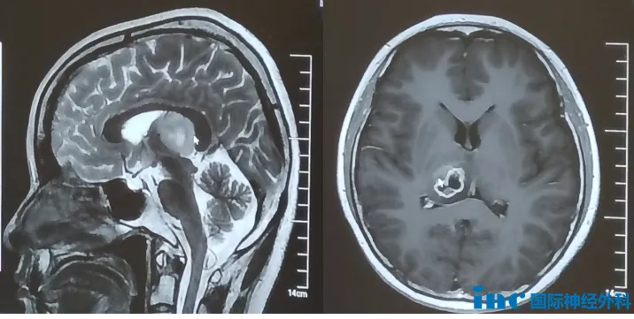 右側丘腦病變，大小約25mm×23mm×24mm，雖然無明顯臨床癥狀