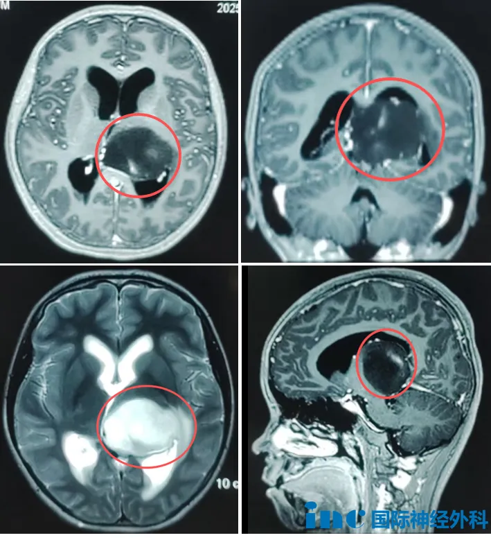 左側(cè)丘腦占位
