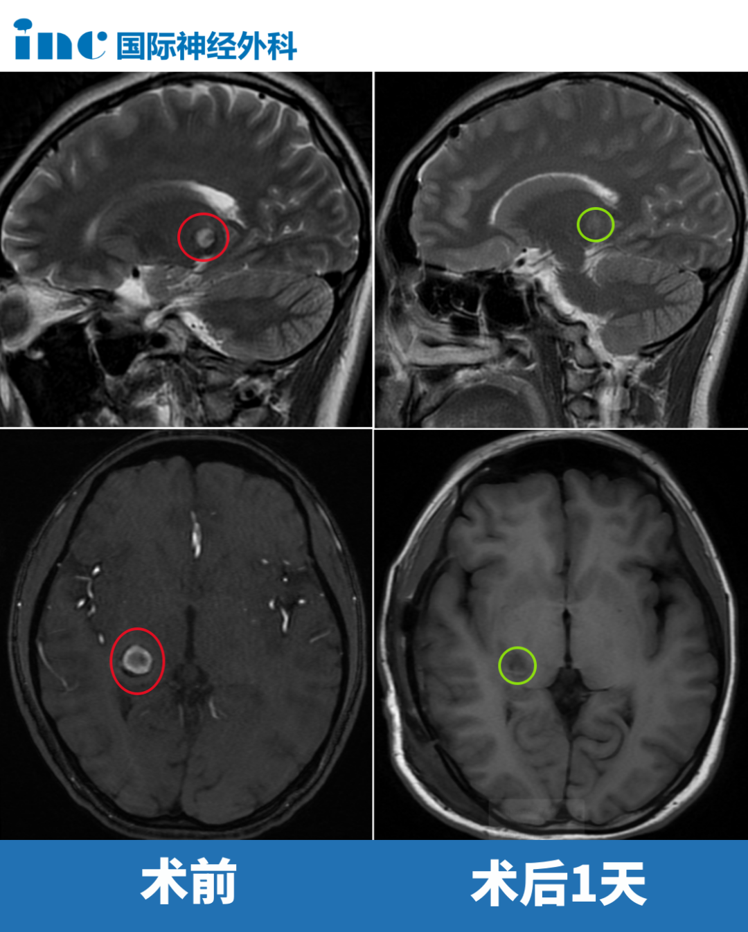 法學(xué)才女丘腦海綿狀血管瘤