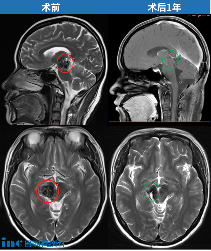 37歲女性丘腦海綿狀血管瘤