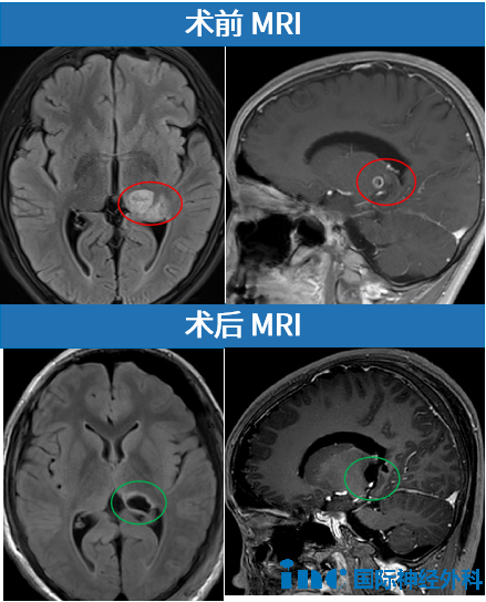 10歲男孩丘腦膠質(zhì)瘤