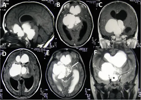 【INC國(guó)際大咖研究成果】造釉細(xì)胞型顱咽管瘤：治療策略的演變