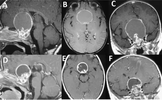 5歲女童顱咽管瘤（AC）的T1加權(quán)MRI掃描顯示