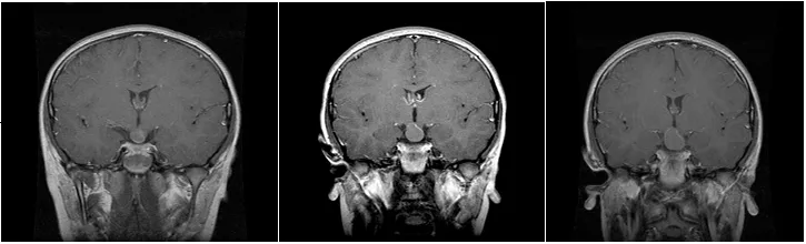 1999年7月因頭痛查出顱咽管瘤，并在2000年1月及4月的復(fù)查中發(fā)現(xiàn)腫瘤不斷生長。