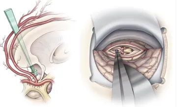 治療：手術(shù)是主要手段