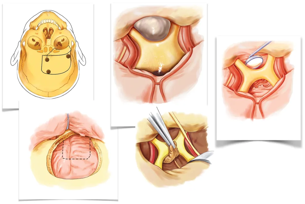 治療：手術(shù)是主要手段