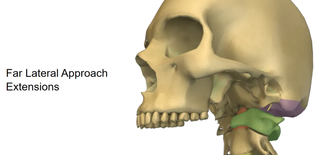 遠(yuǎn)外側(cè)入路的擴(kuò)展應(yīng)用與穩(wěn)定性考量