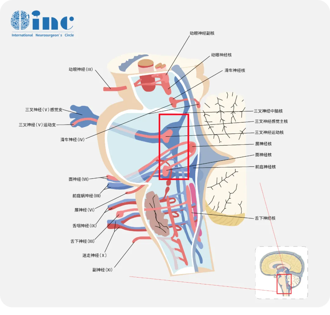 腦干海綿狀血管瘤