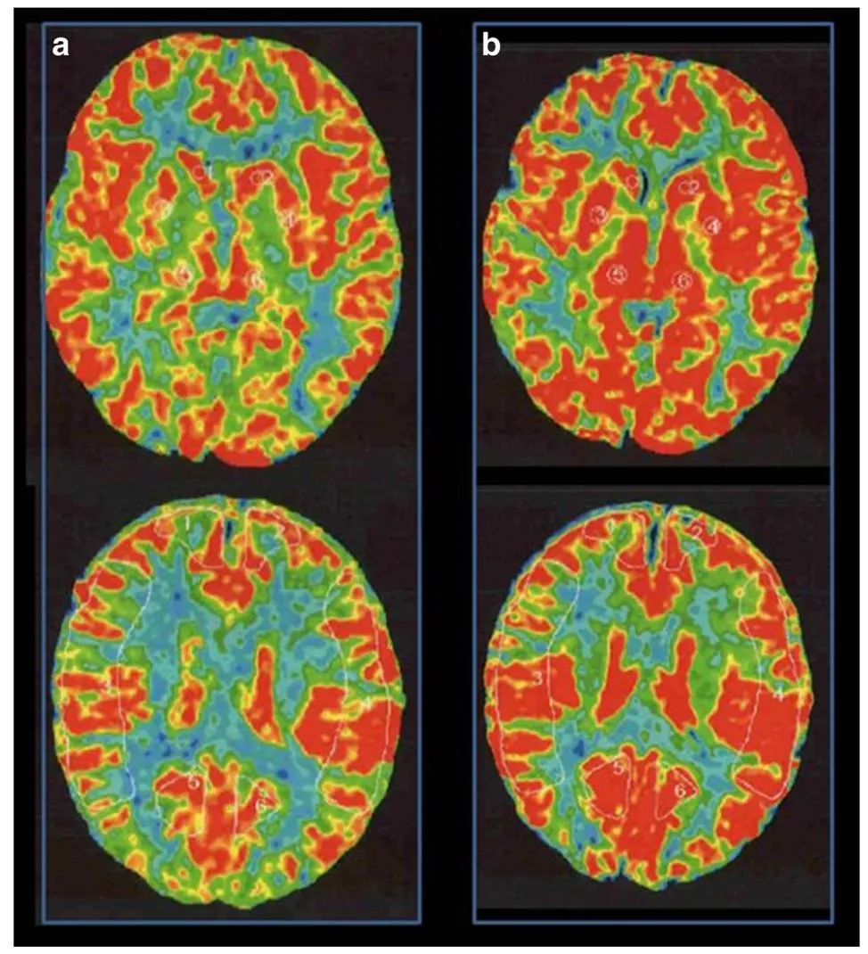 10歲女孩頭痛背后藏危機(jī)：竟是兒童煙霧病早期信號？