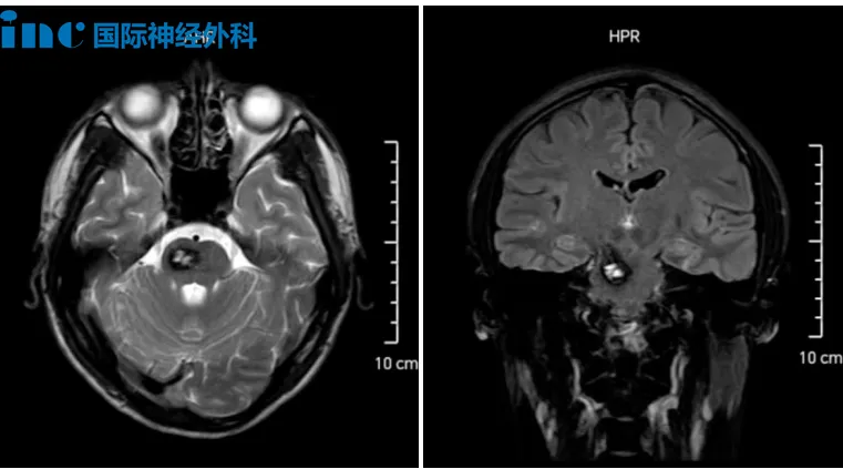 21歲男孩頭暈查出右側(cè)大腦腳、腦干血管瘤伴出血