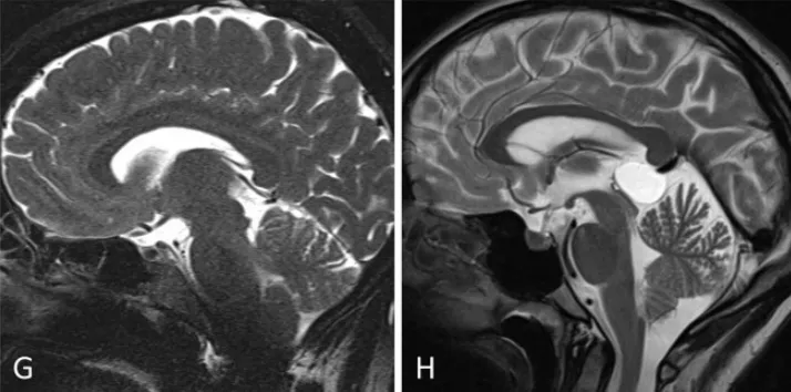 小腦幕傾斜度變異分析