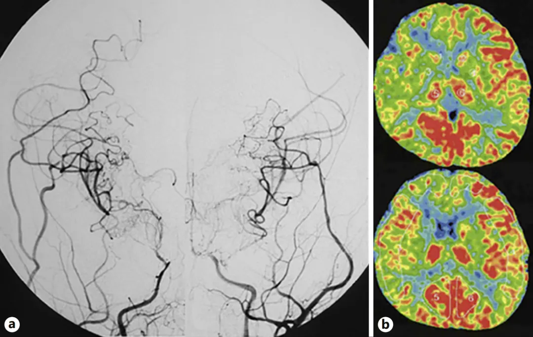 圖a：第二次手術半年后，雙側頸內動脈血管造影顯示側支血管網(wǎng)絡發(fā)育良好，基底煙霧血管消退。  　　圖b：雙側腦血流顯示有所改善。