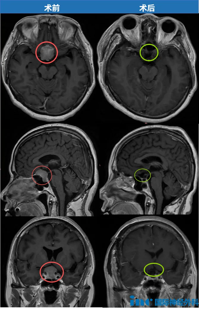 鞍區(qū)腦膜瘤