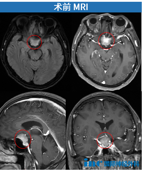鞍區(qū)腦膜瘤影像