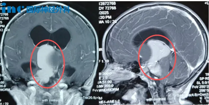 術(shù)前MRI，小安腦中的“大蟲子”
