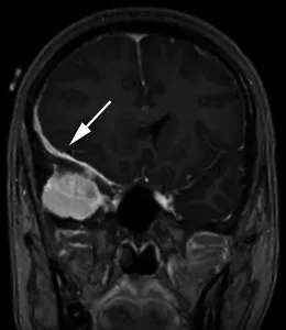 一名35歲頭痛女性的造影后冠狀T1加權(quán)序列顯示