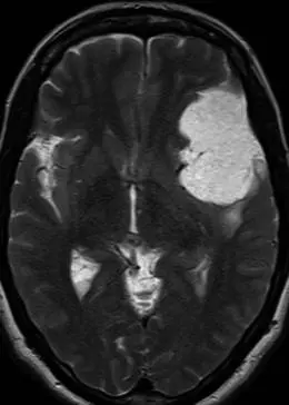 一名有8年暈厥發(fā)作史的55歲女性的軸向T2加權(quán)序列顯示