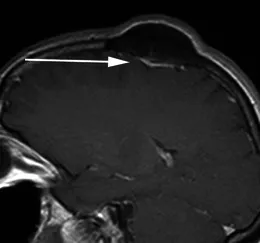 一名49歲女性患者，因頭皮腫塊就診