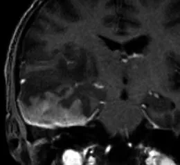 63歲濾泡性淋巴瘤病史男性患者