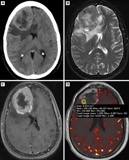 一名49歲患者，經(jīng)病理證實(shí)為3級(jí)（間變性）腦膜瘤
