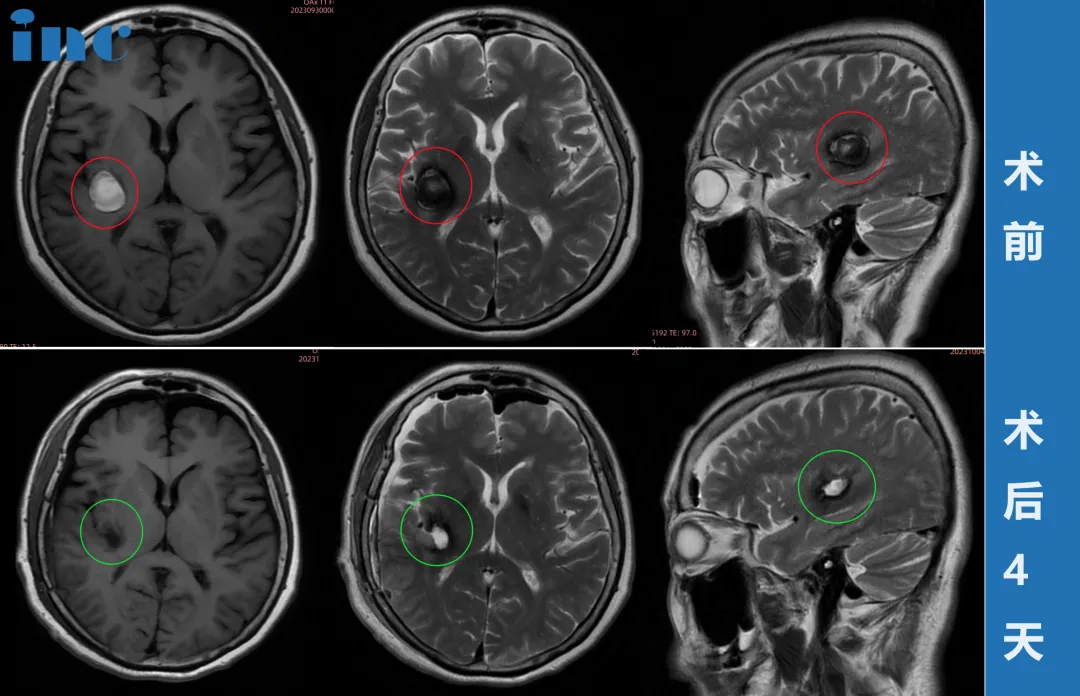 基底節(jié)區(qū)海綿狀血管瘤影像