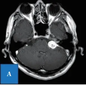 聽神經(jīng)瘤遇上頸靜脈球高位？INC川島教授如何破解手術(shù)困局