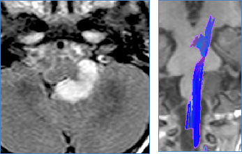 孩子確診腦干膠質(zhì)瘤，我們還有機(jī)會(huì)嗎？開顱對(duì)成長(zhǎng)有影響嗎？解讀預(yù)后關(guān)鍵可控因素