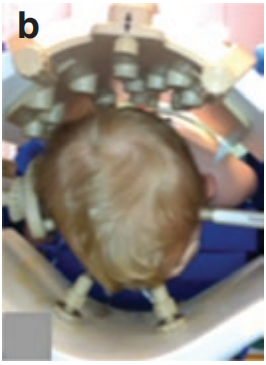 術(shù)中T1和T2MR（圖c和d）