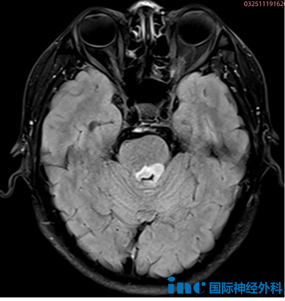 “巴教授可以盡快為我手術(shù)嗎？”12月下旬，他們與德國神外大咖攜手奔赴“生命之約”