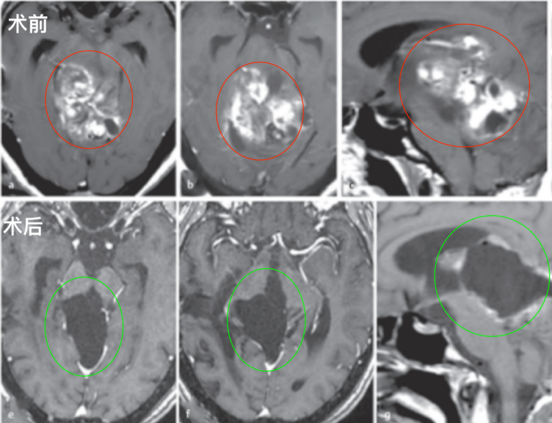 兩次手術(shù)僅活檢，放療無效…良性腦干膠質(zhì)瘤治療深陷“泥潭”，她如何全身而退？