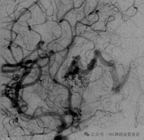 該AVM由ACA/PcaA分支、ACoA穿支和mPChA供血[右側(cè)ICA造影