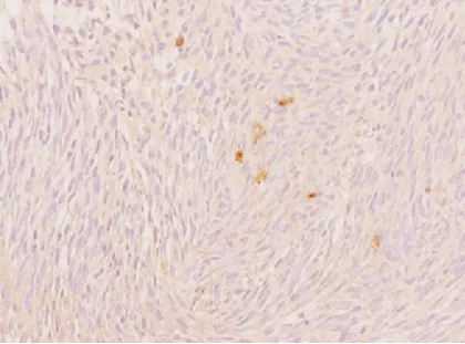 S100蛋白彌漫陽性免疫組織化學(xué)染色。原始放大倍數(shù)×200。
