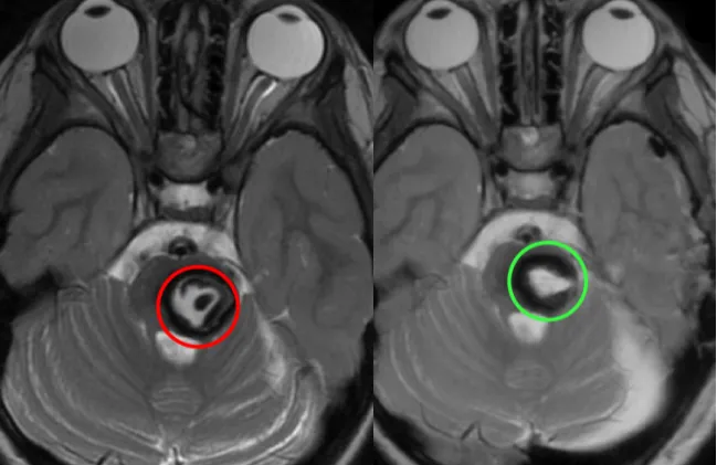 術(shù)后即復(fù)查顱腦MR顯示病變?nèi)?，無(wú)腦水腫、出血等，瘤腔內(nèi)高信號(hào)灶是止血材料（紅色術(shù)前，綠色術(shù)后）。