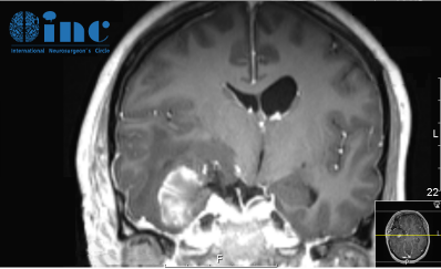 術(shù)后一周復查磁共振增強，術(shù)區(qū)高信號為暫時未吸收的止血材料等