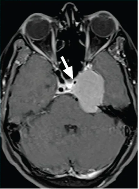 圖：海綿竇腦膜瘤合并左側(cè)頸內(nèi)動脈狹窄，手術(shù)難度大
