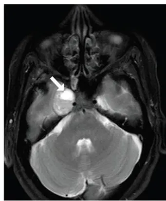 海綿狀神經(jīng)鞘瘤，瘤內(nèi)間囊變，實性部分明顯強化。