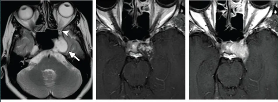 海綿竇血管瘤，T2高信號，累及左側(cè)Meckel腔