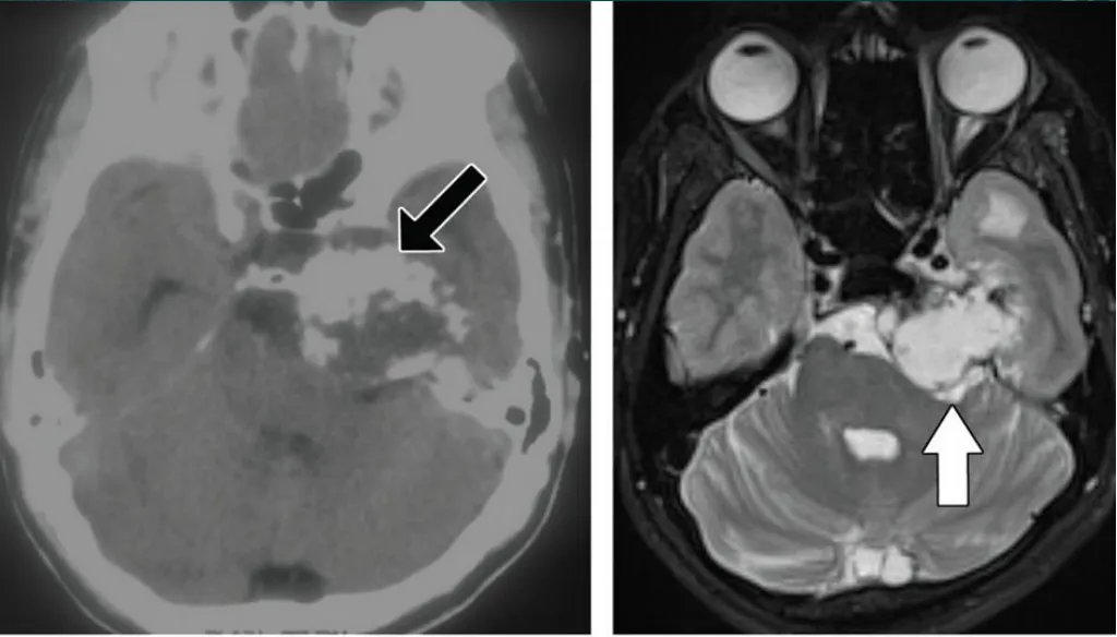 軟骨肉瘤，巖尖膨脹性骨質(zhì)破壞，累及左側(cè)海綿竇后部