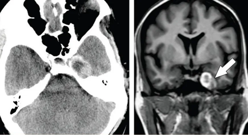 圖：海綿竇黑色素瘤，和海綿狀血管瘤容易混淆