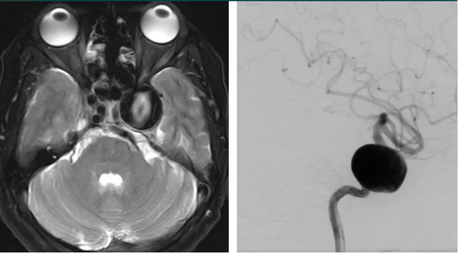圖：海綿竇區(qū)頸內(nèi)動脈瘤