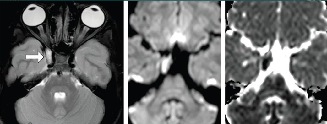 海綿竇區(qū)表皮樣囊腫