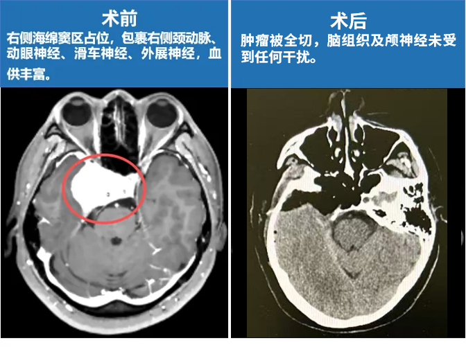 1、累及海綿竇的腦膜瘤可以分為3類