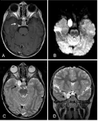 圖1：病灶在t1加權(quán)像上呈低信號，周圍有高信號，在t2加權(quán)像上呈高信號且不均勻。增強檢查除了病灶邊邊緣輕微強化，未見增強。病變壓迫海綿竇內(nèi)頸動脈(ICA)。