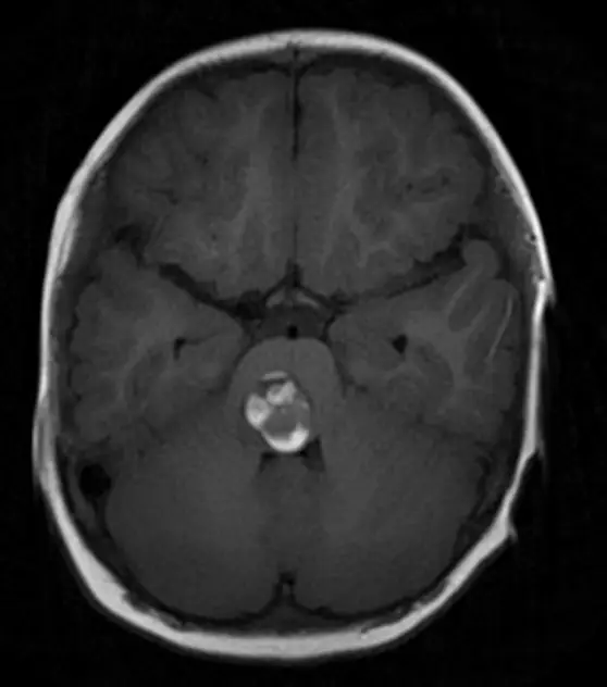 “能救孩子，我們在所不惜！”2歲女兒腦干出血，全切術后癥狀消失！