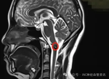 從反復出血到重獲新生：一位延髓海綿狀血管瘤患者的四年求醫(yī)路