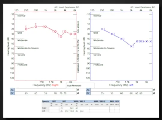 （術(shù)后聽力圖）