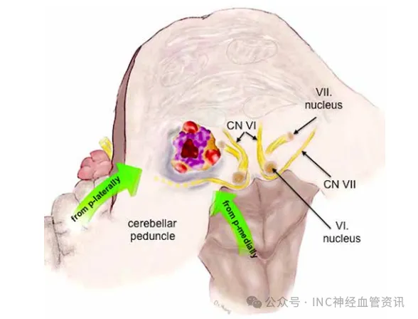 橋腦海綿狀血管瘤病變位置，血管病變不鄰接橋腦表面，但它單側(cè)移動(dòng)周圍的固有結(jié)構(gòu)，包括外展神經(jīng)和面神經(jīng)。