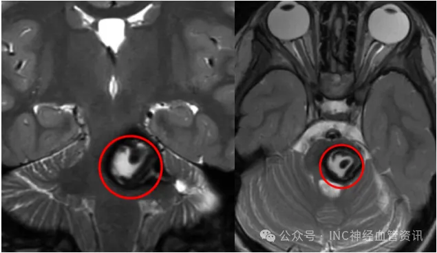 4歲女童西西突發(fā)頭痛嘔吐，被確診為腦干海綿狀血管瘤，面臨手術與觀察的艱難抉擇